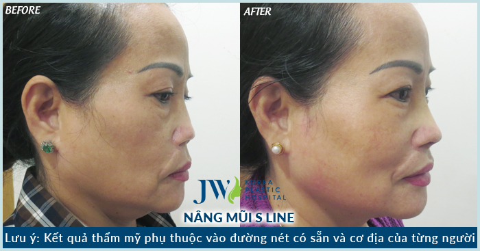 Mũi của chị Thu Loan thay đổi sau khi phẫu thuật tại JW.